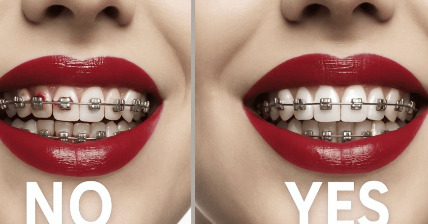 How To Wear Lipstick With Braces As An Adult